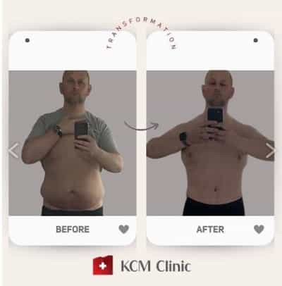 KCM Clinic in Jelenia Gora, Poland Before and After Gastric Sleeve 