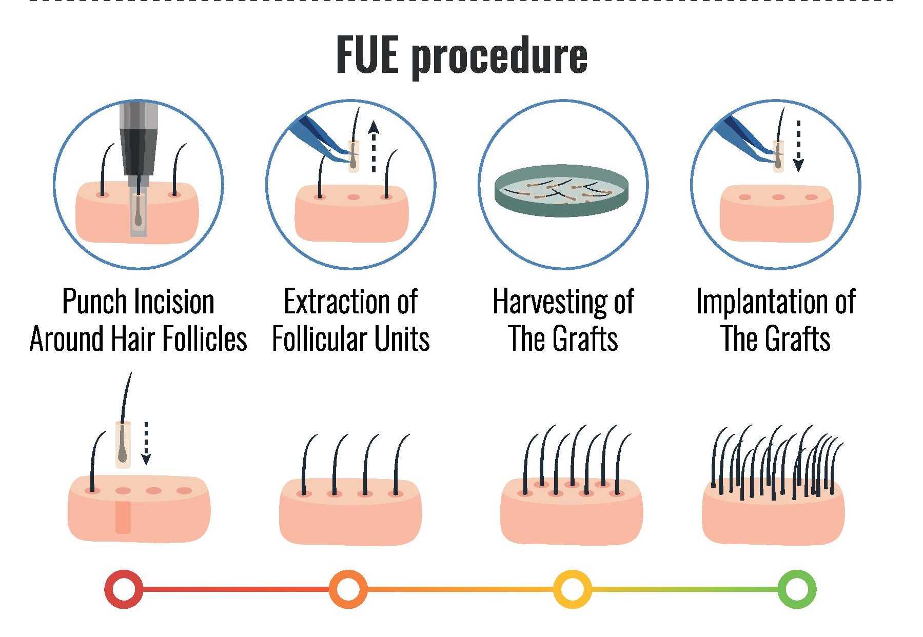 Fue Hair Transplant