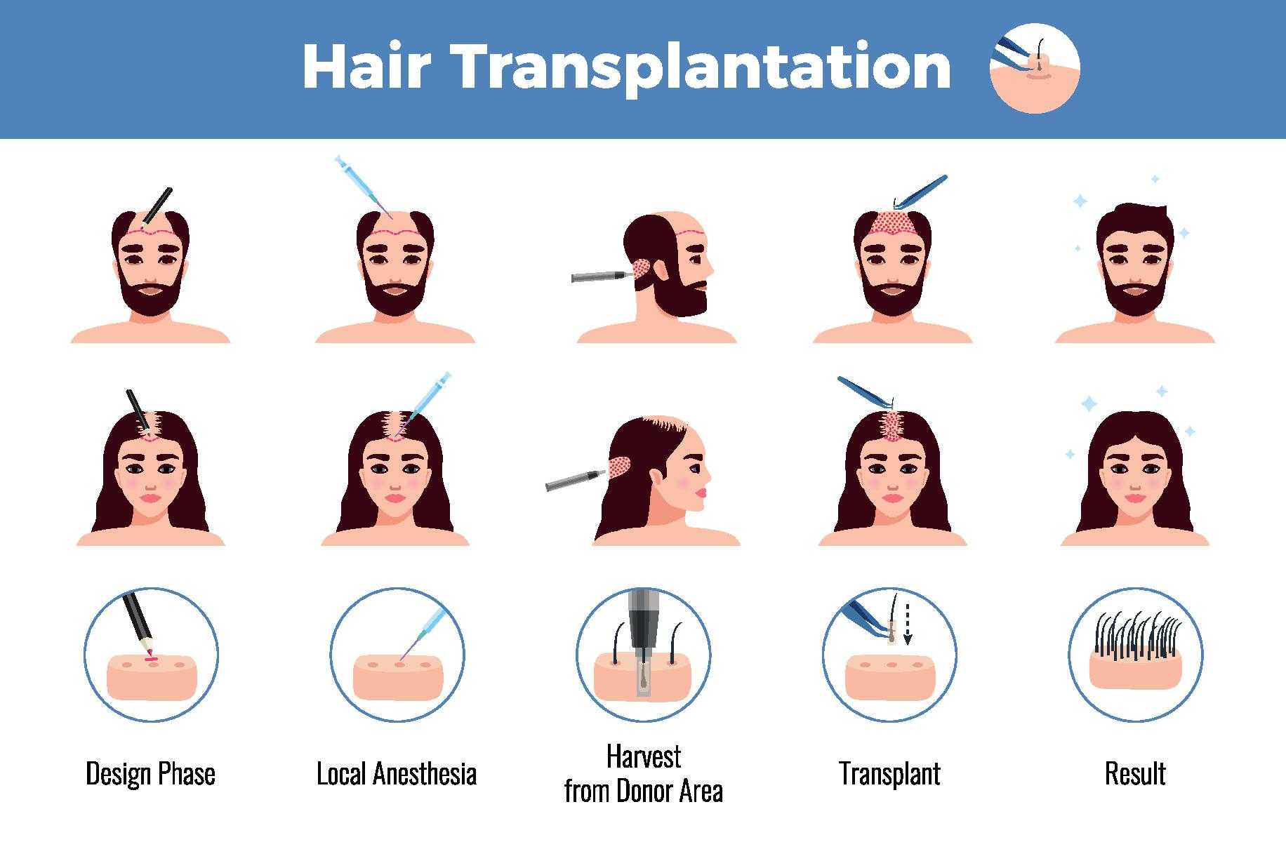 Hair Transplant Procedure