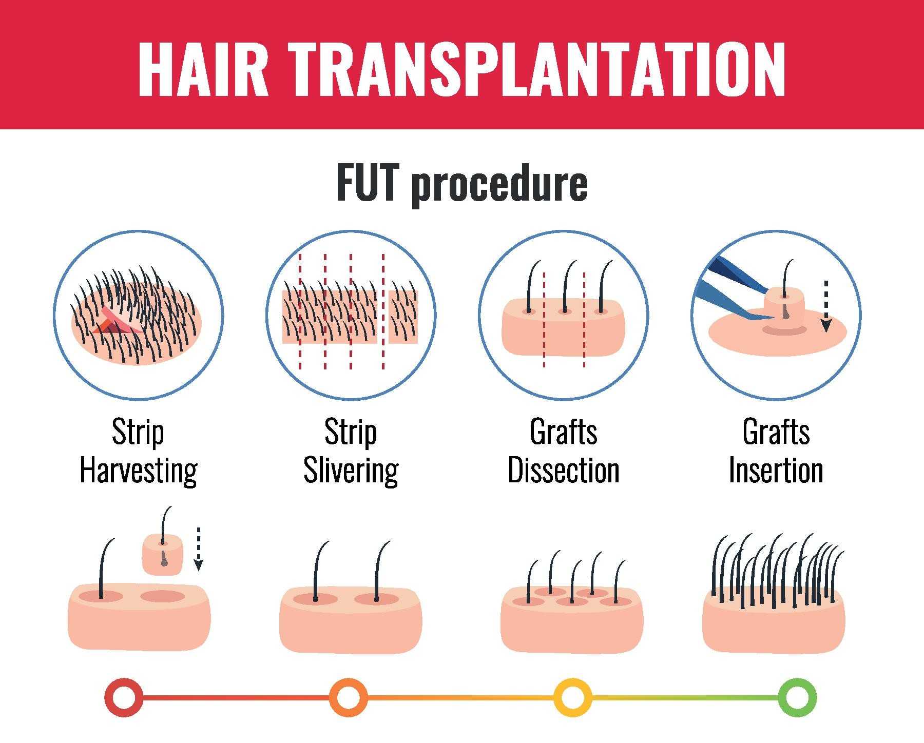 Follicular Unit Transplantation (FUT)
