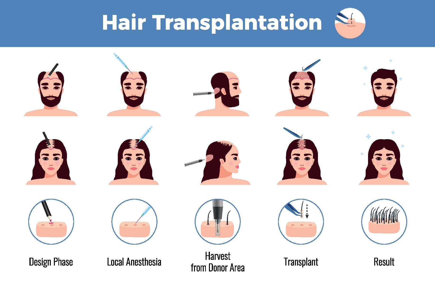 Procedure of Hair Transplant in Mexico Vs Turkey