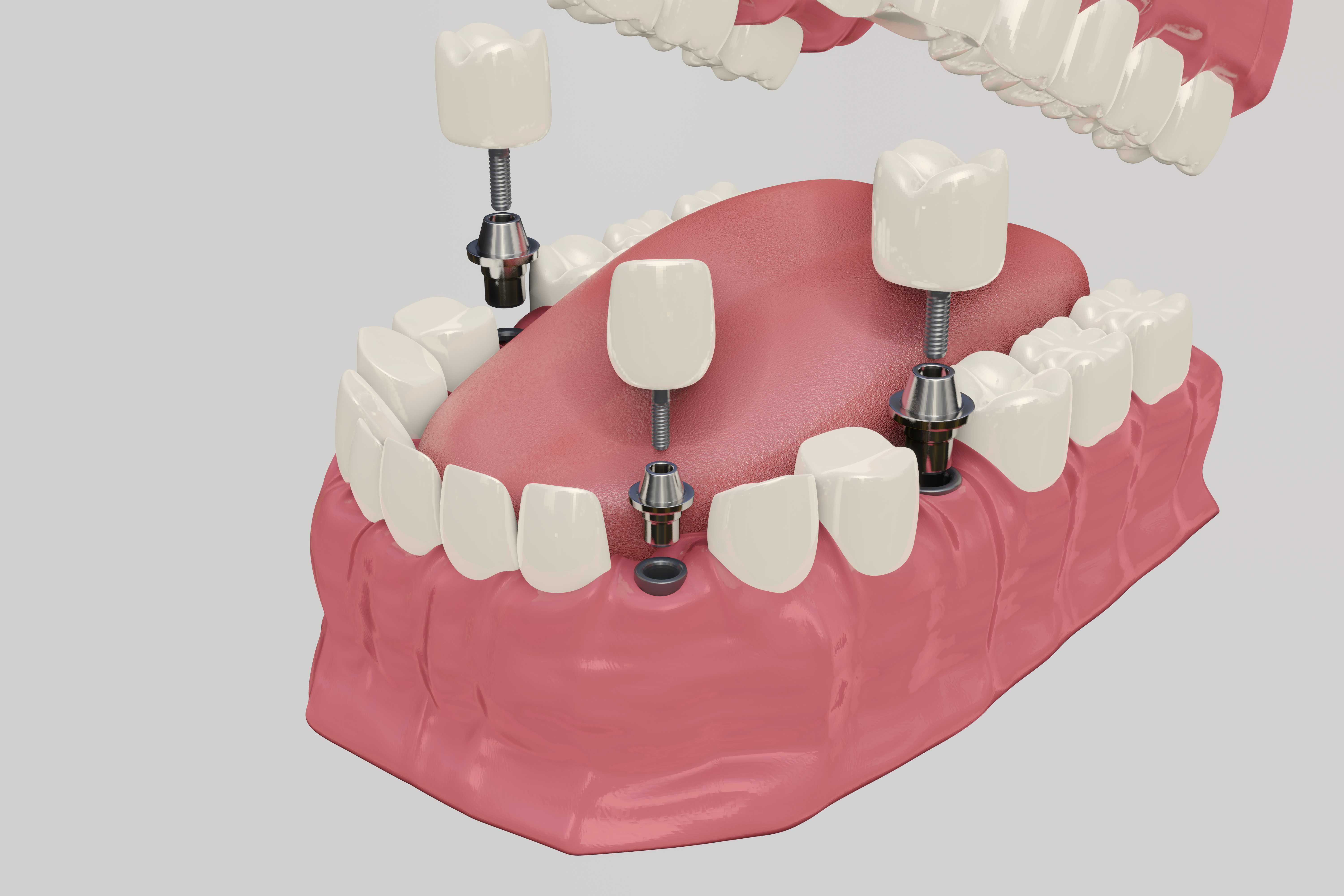 Dental Implant