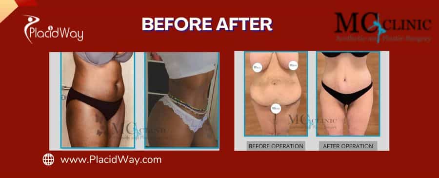 Before After Abdominoplasty