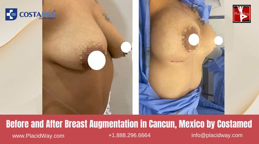 Before and After Breast Augmentation by Costamed