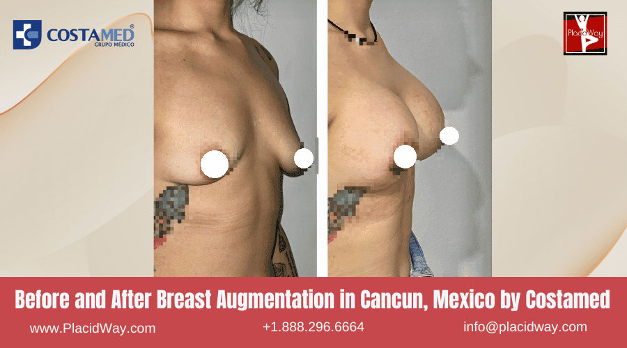 Before and After Breast Augmentation in Cancun by Costamed