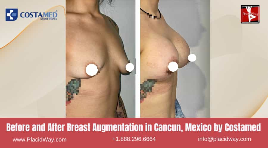 Before and After Breast Augmentation in Cancun by Costamed