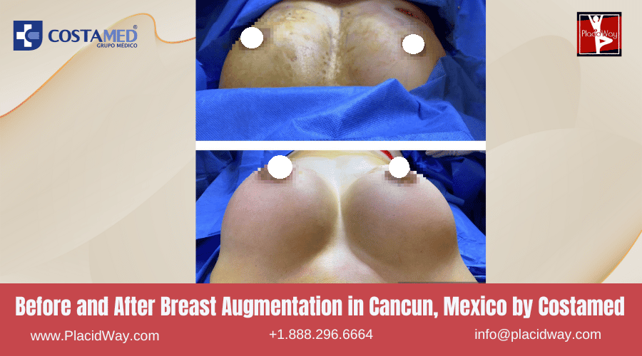 Before and After Breast Implant by Costamed