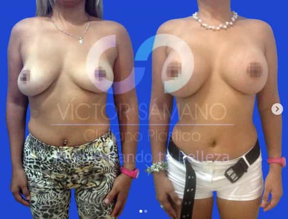 breast implant cancun mexico