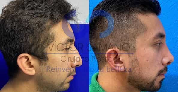 Rhinoplasty in cancun before after images