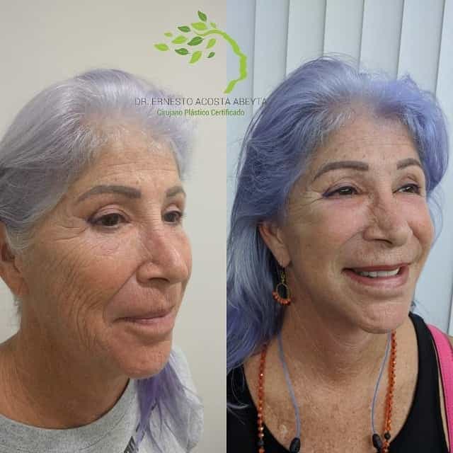 Facelift in Merida Mexico Before After