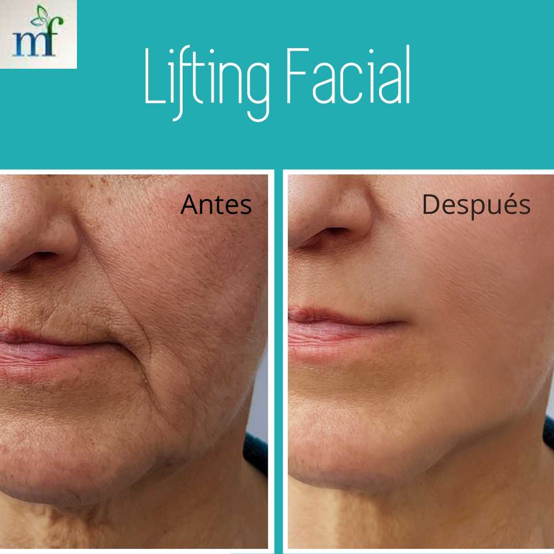 Facelift Before After in Merida, Mexico by Medina Flores