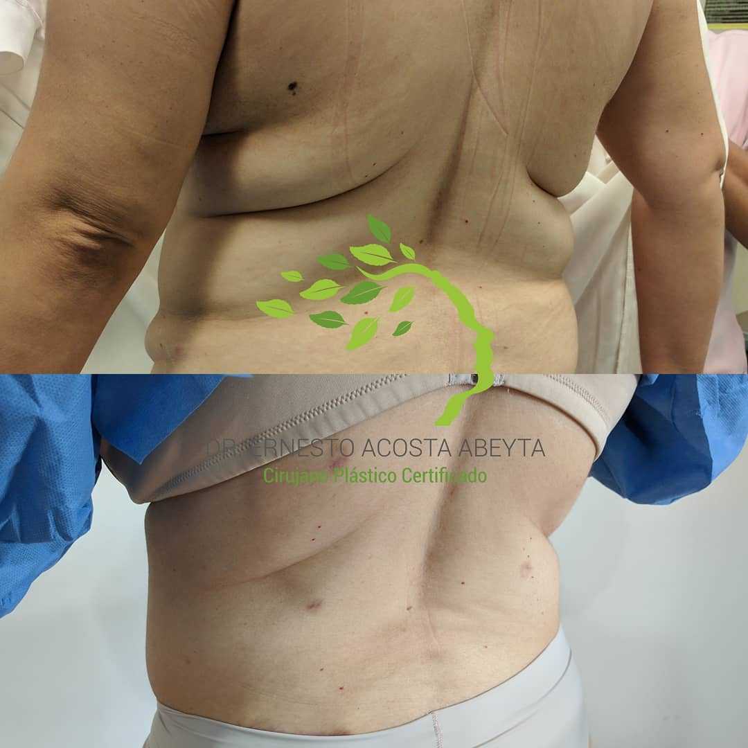 Lipo before after image ernesto acosta