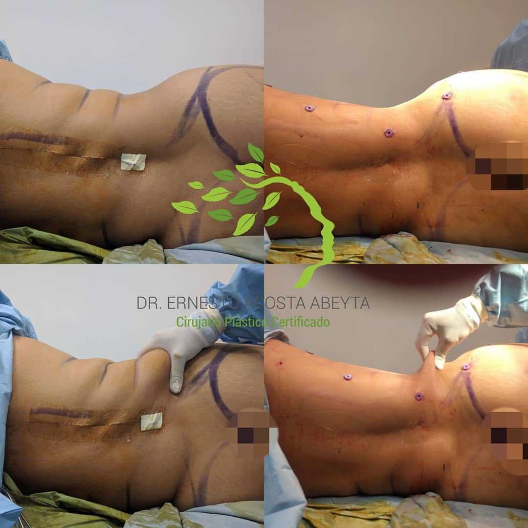 Lipo before after image ernesto acosta in merida