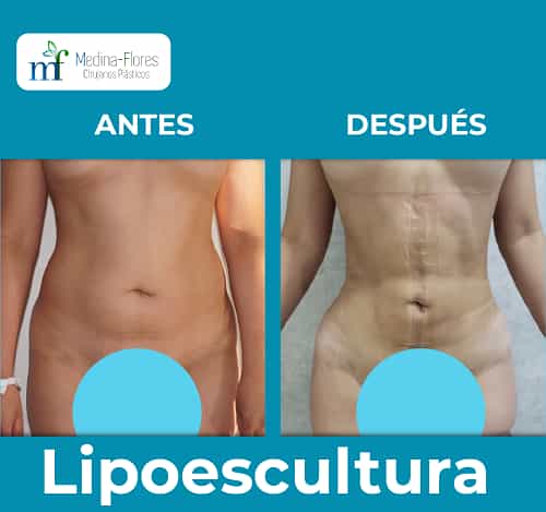 Medina Flores - Fotos de antes y después de liposucción