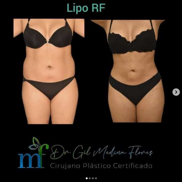 Medina Flores - Lipo Before After in Merida