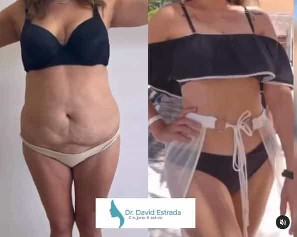 Dr. David Estrada in Cancun, Mexico Lipo Before After