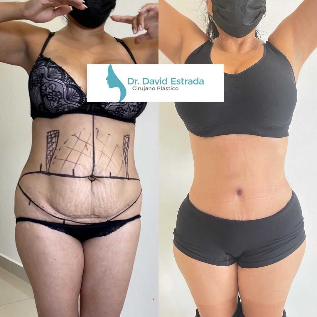 David Estrada - Abdominoplasty in Cancun, Mexico