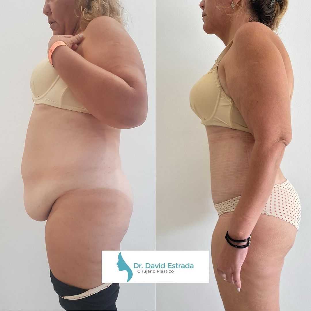 Tummy Tuck in Cancun, Mexico
