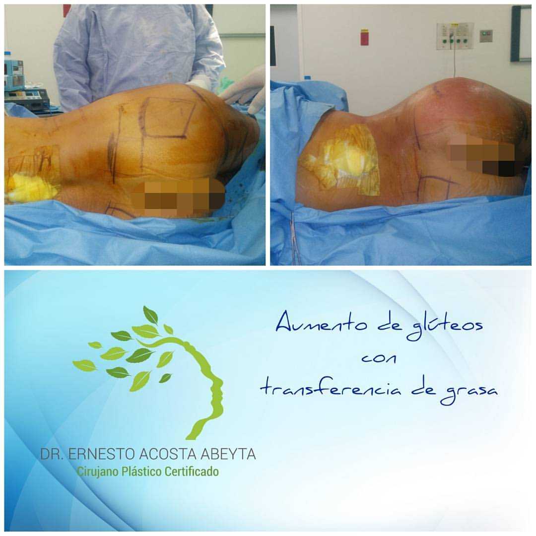 Levantamiento de Glúteos Brasileño en Mérida, México Fotos de Antes y Después de Ernesto Abeyta