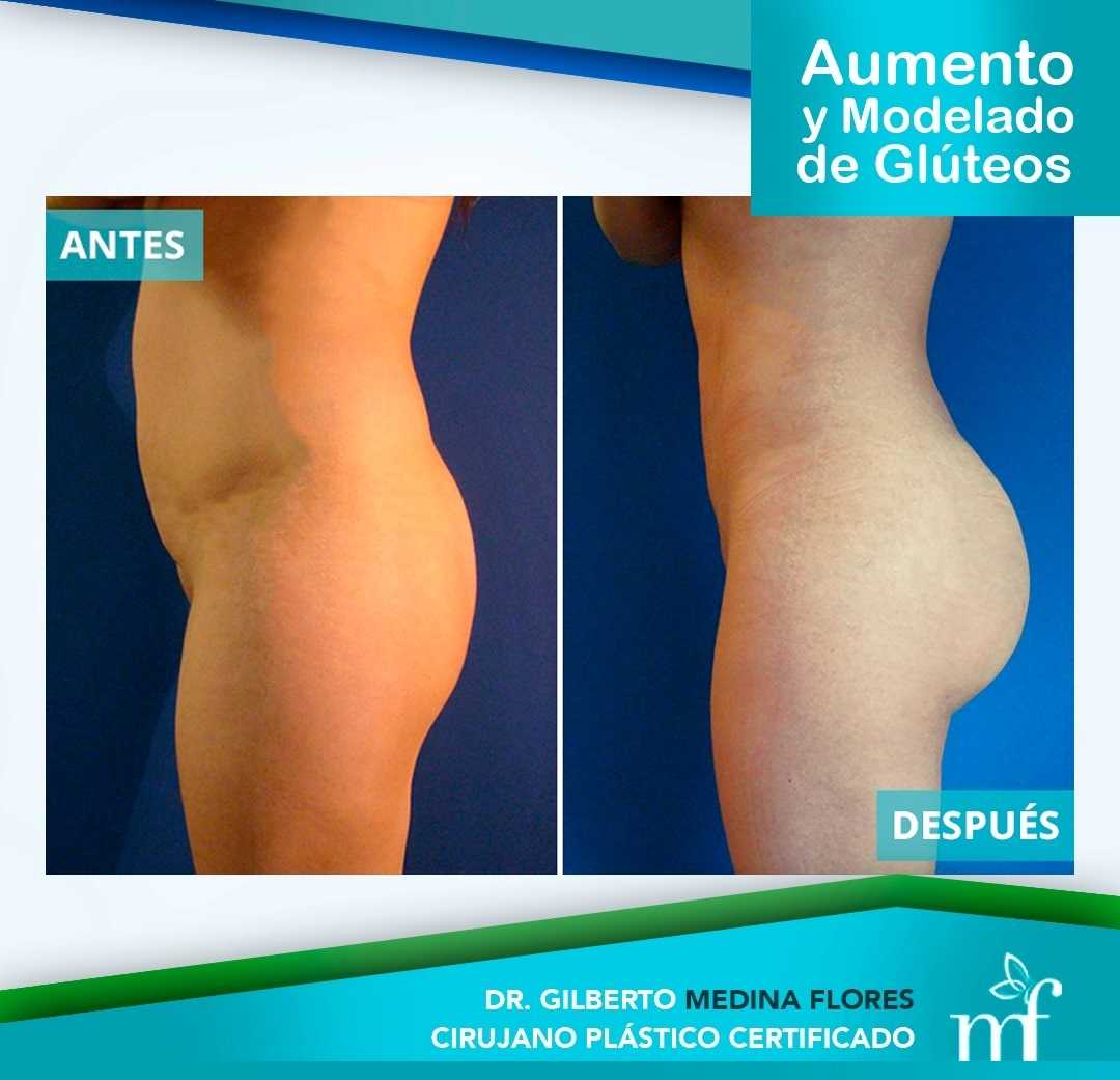 Brazilian Butt Lift in Merida, Mexico Before and After Images