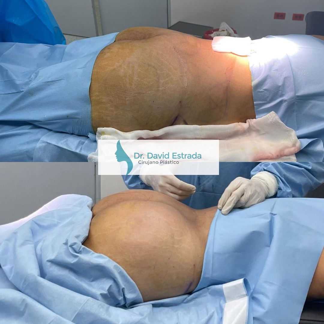 Brazilian Butt Lift in Cancun, Mexico Before and After Images