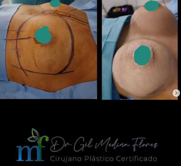 Breast Implant in Merida, Mexico Before and After Images