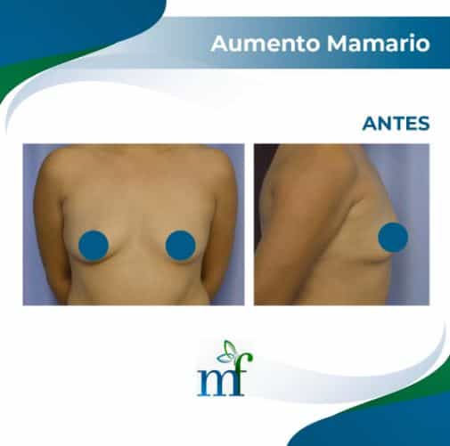 Breast Augmentation in Merida, Mexico Before and After Images