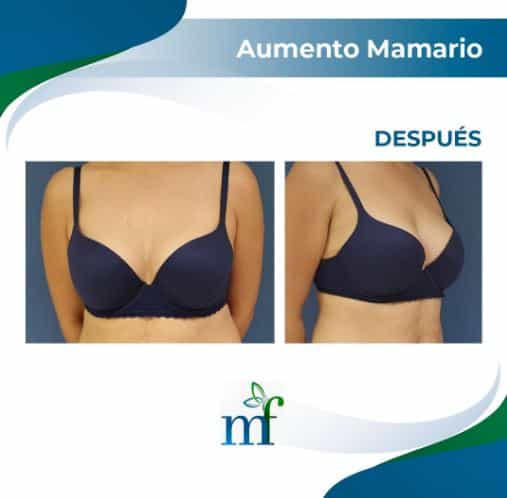 Breast Implant in Merida, Mexico Before and After Pictures