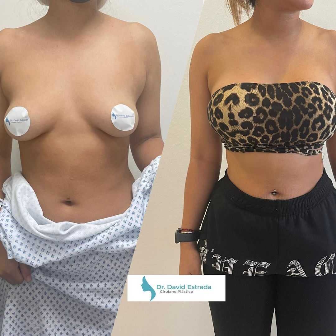Before After Breast Implant in Cancun Mexico by Dr. David Estrada 1
