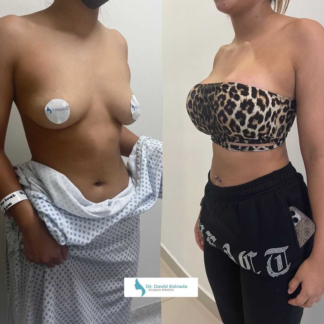 Before After Breast Augmentation in Cancun Mexico by Dr. David Estrada
