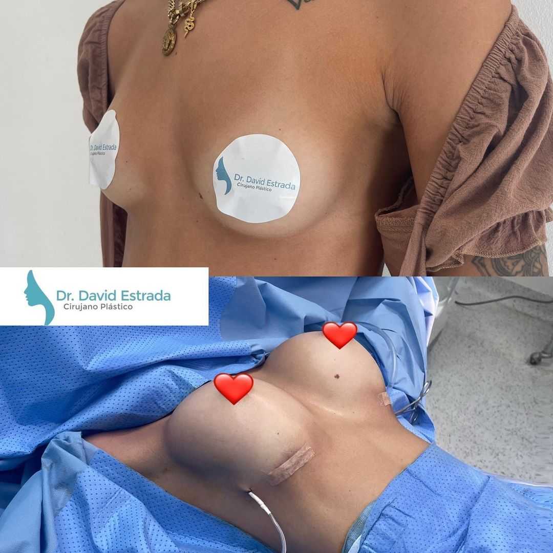 Before After Breast Augmentation in Cancun Mexico by Dr. David Estrada