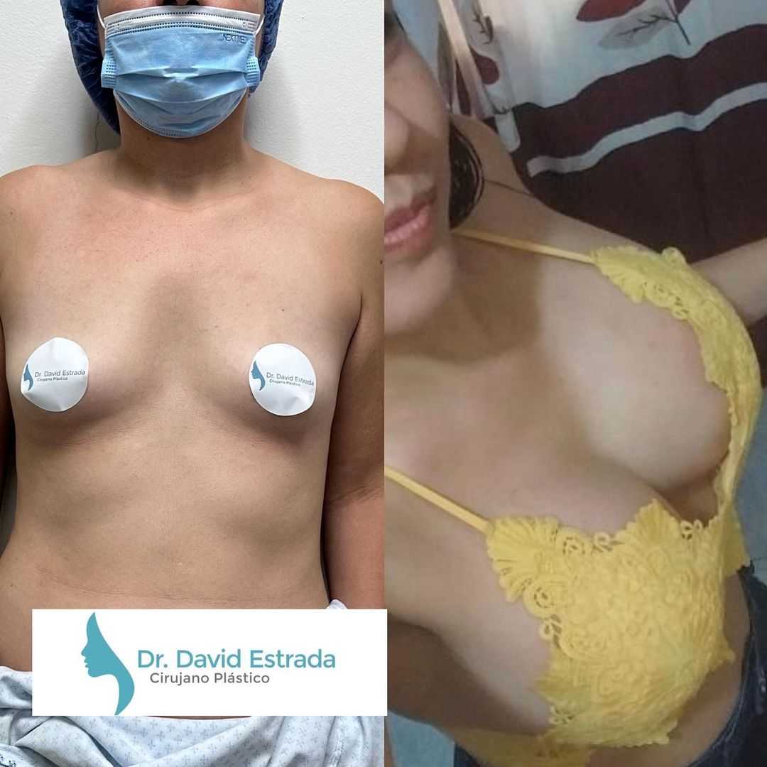Before After Breast Augmentation Images in Cancun Mexico by Dr. David Estrada