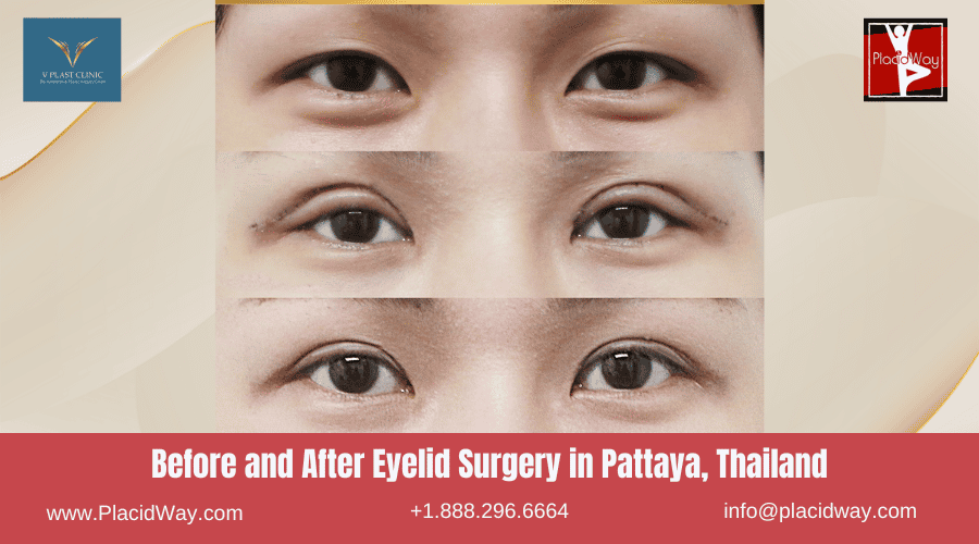 Before and After Eyelid Surgery in Pattaya, Thailand Image