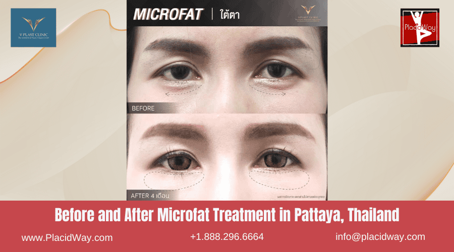 Before and After Microfat Treatment in Pattaya, Thailand