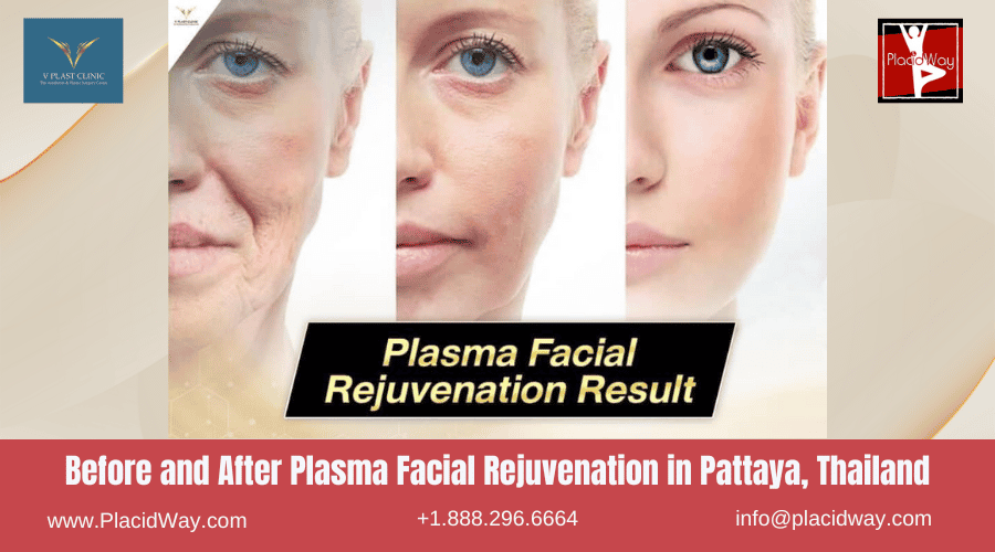 Before and After Plasma Facial Rejuvenation in Pattaya, Thailand