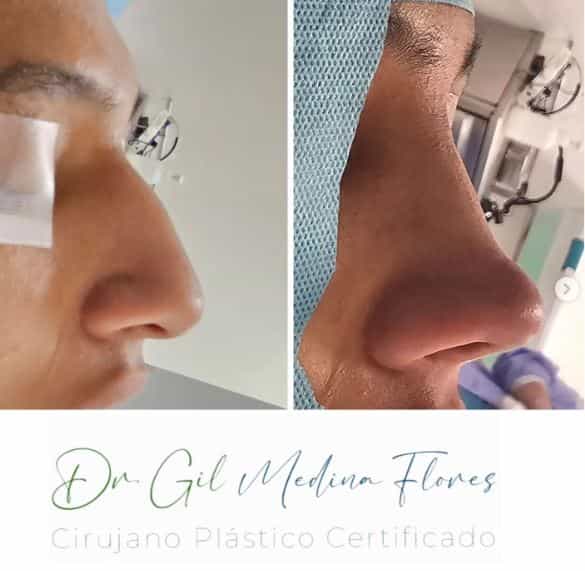Nose Surgery in Merida, Mexico Before and After Pictures
