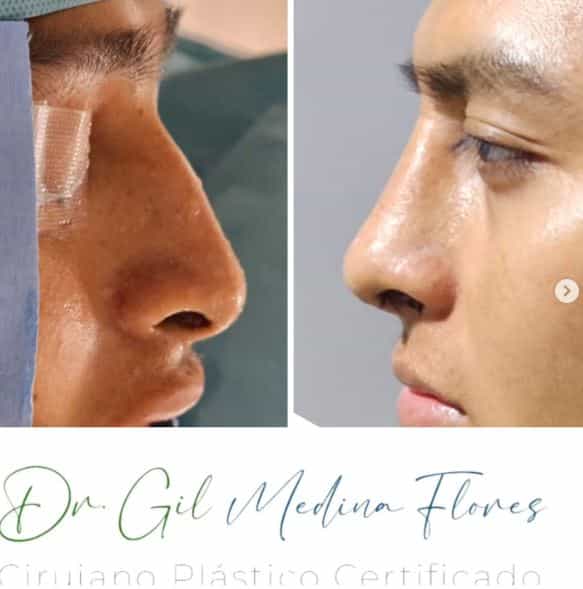 Before and After Images for Nose Surgery in Merida, Mexico