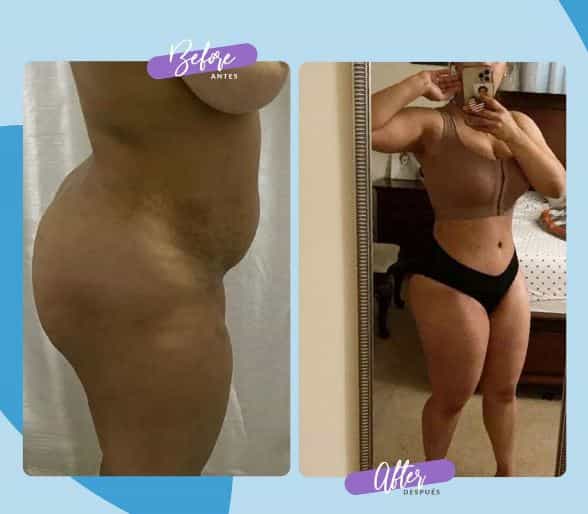 Imagen de antes y después de la abdominoplastia