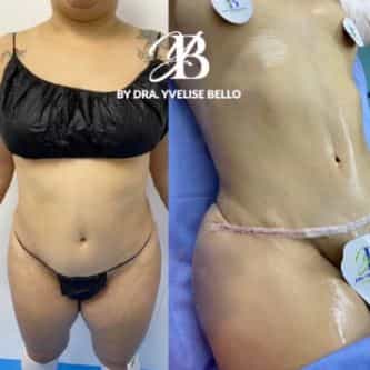 Tummy Tuck Before After El Vergel Clinic