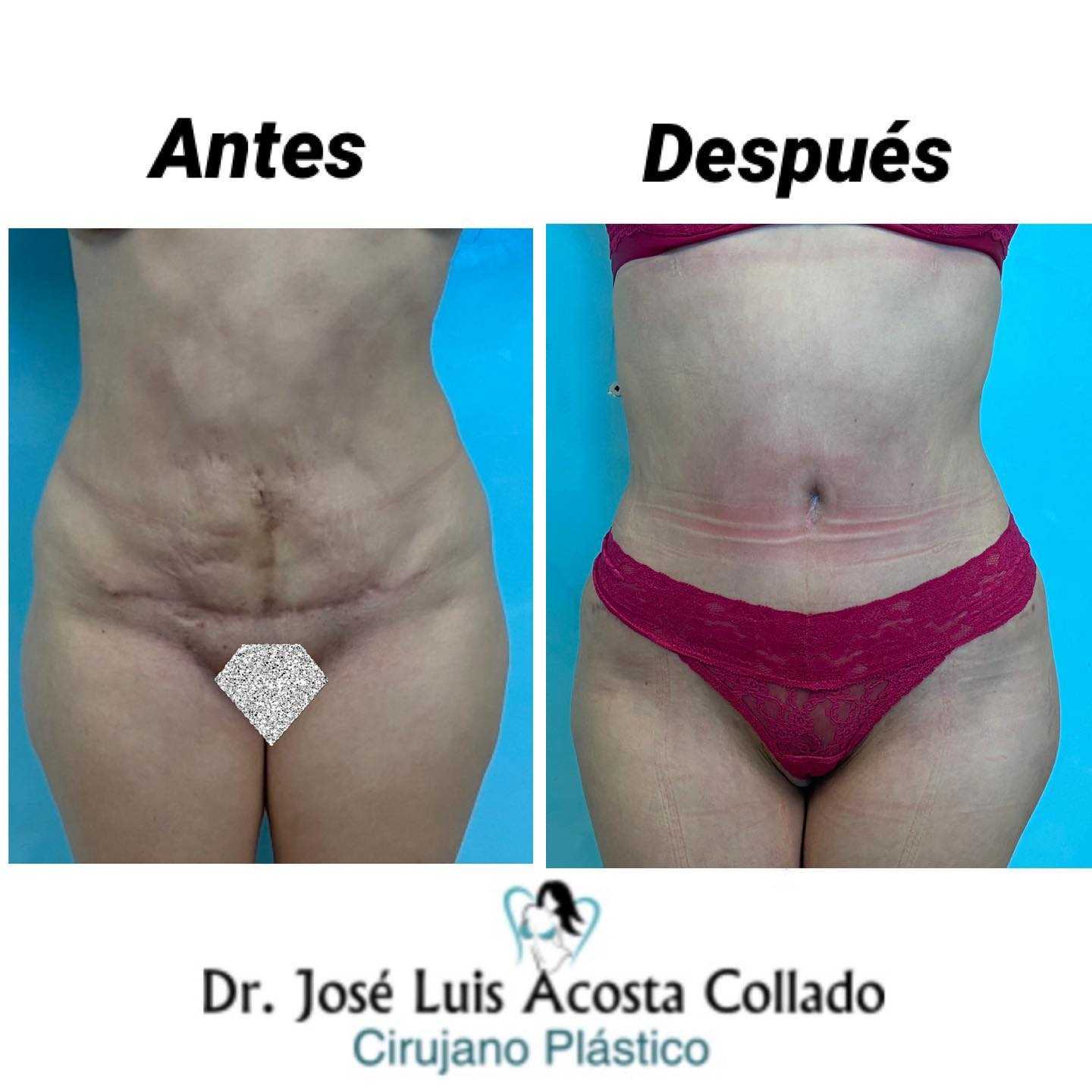 Before After Tummy Tuck Package in Santo Domingo, Dominican Republic by CIPLA