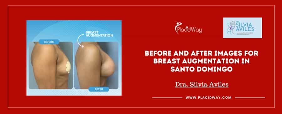 Breast Augmentation by Dr Silvia