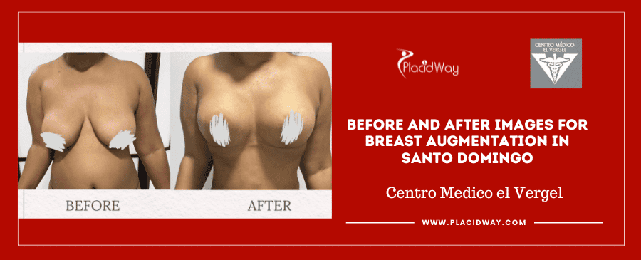 Before and After Images for Breast Augmentation in Santo Domingo