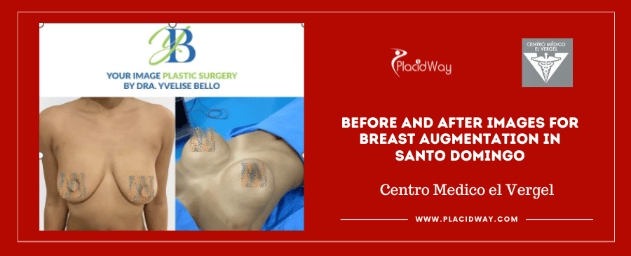 Before and After Images for Breast Augmentation in Santo Domingo