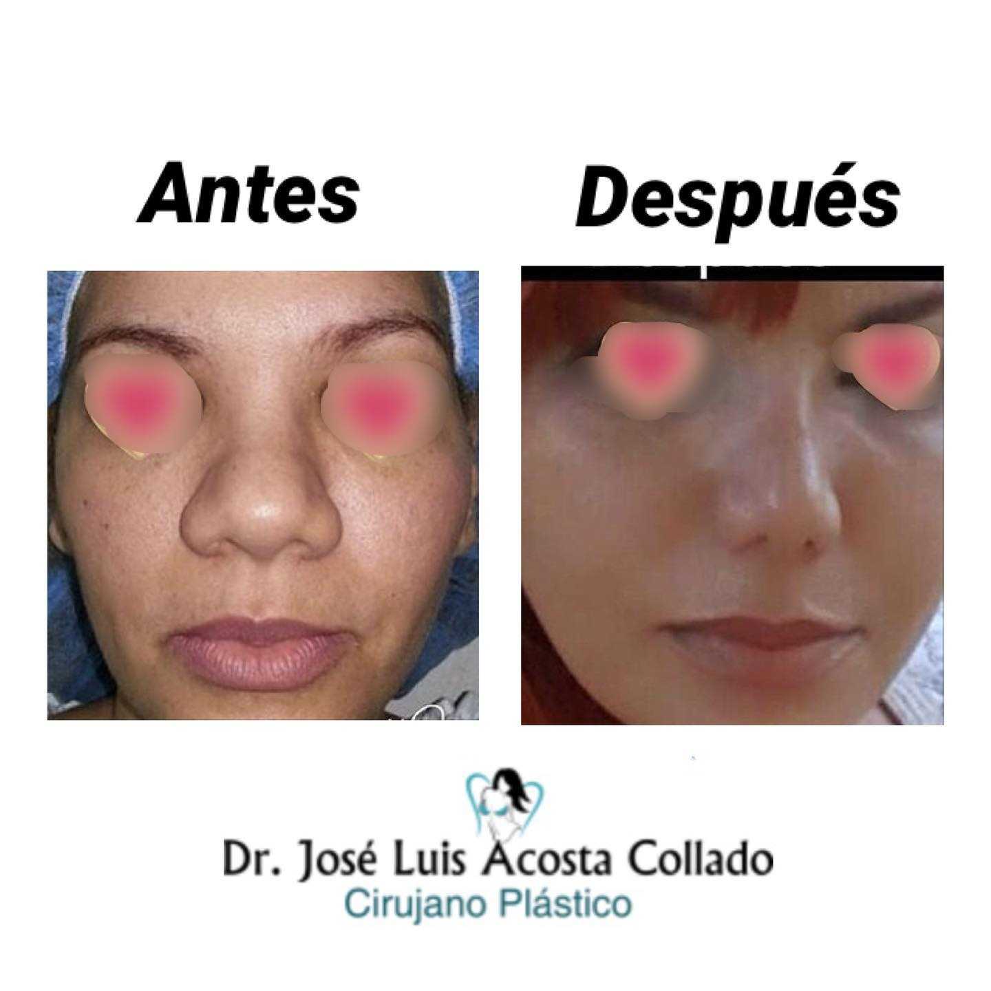 Before After Images Rhinoplasty in Santo Domingo, Dominican Republic by CIPLA