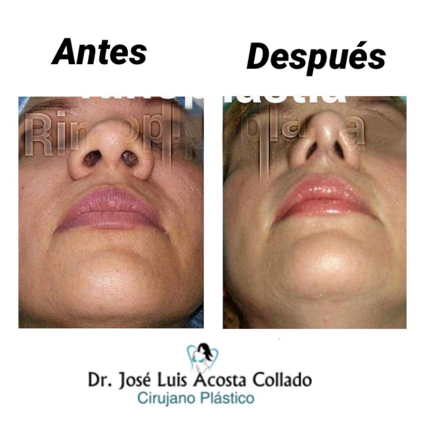 Before After Images Rhinoplasty in Santo Domingo, Dominican Republic by CIPLA