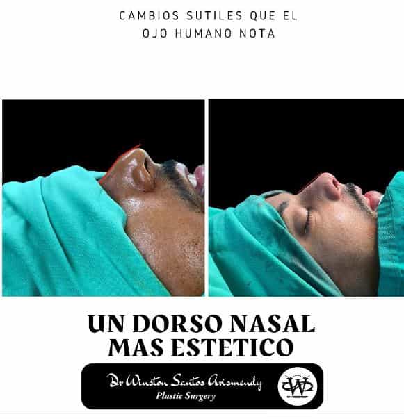 Before After Rhinoplasty in Punta Cana, Dominican Republic by Dr. Winston Santos Arismendy