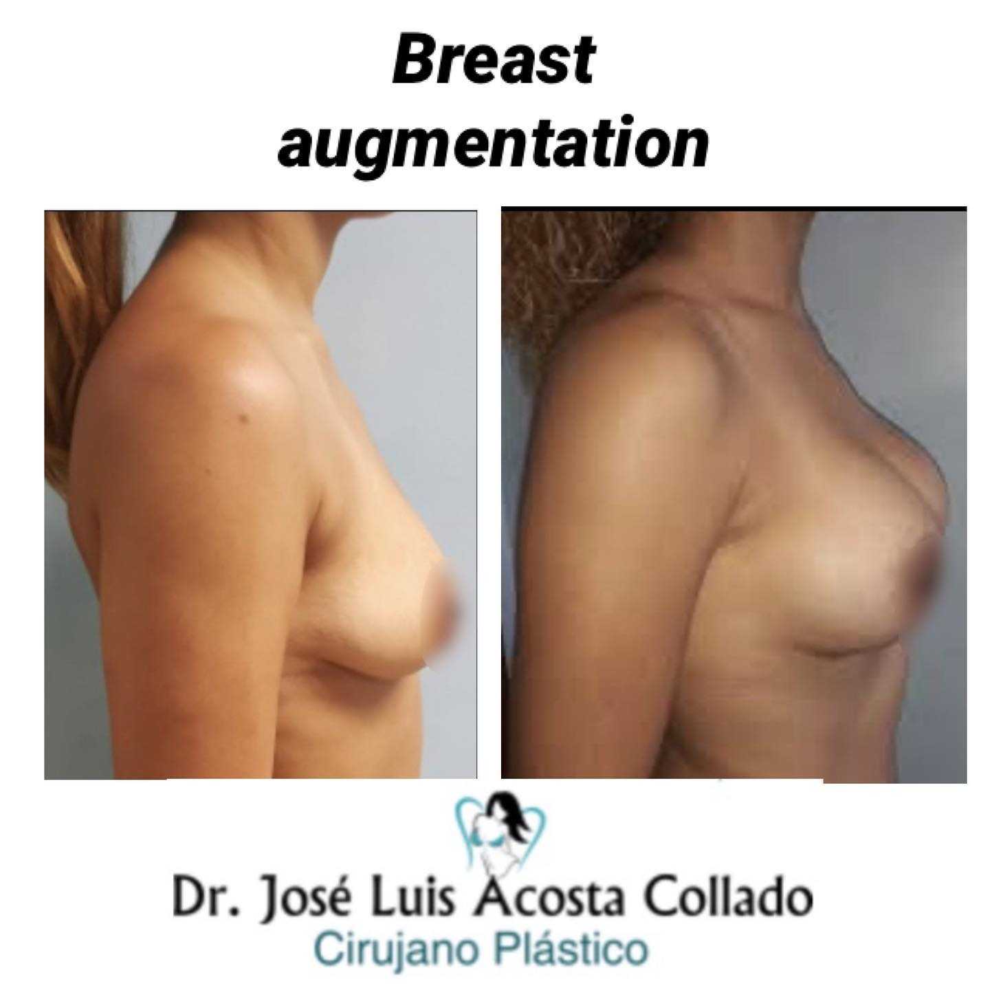Breast Augmentation Before After Image in Santo Domingo, Dominican Republic by CIPLA