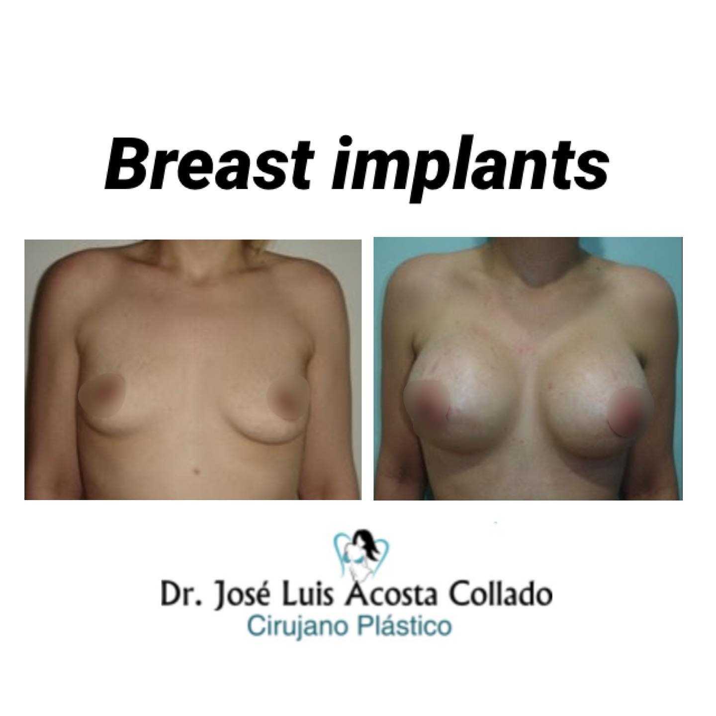 Breast Augmentation in Santo Domingo, Dominican Republic by CIPLA Before After Image 