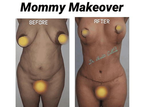 Mommy Makeover before and after image