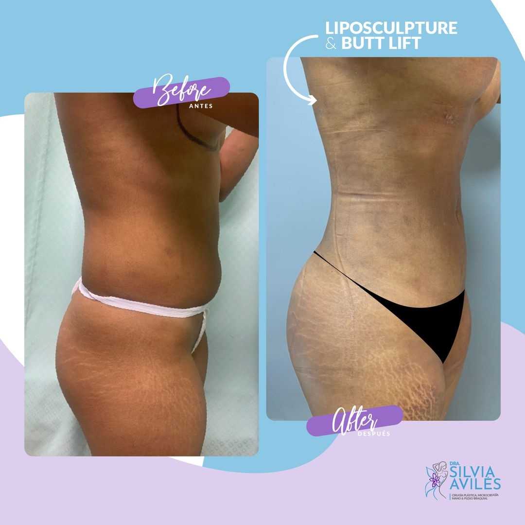 Liposuction in Santo Domingo, Dominican Republic Before After Images